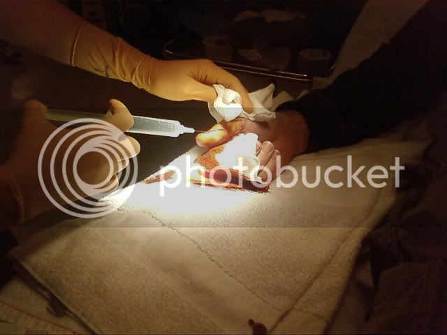 CHRIS BRODERICK CUTS THUMB ON RIGHT HAND WITH BOX CUTTER